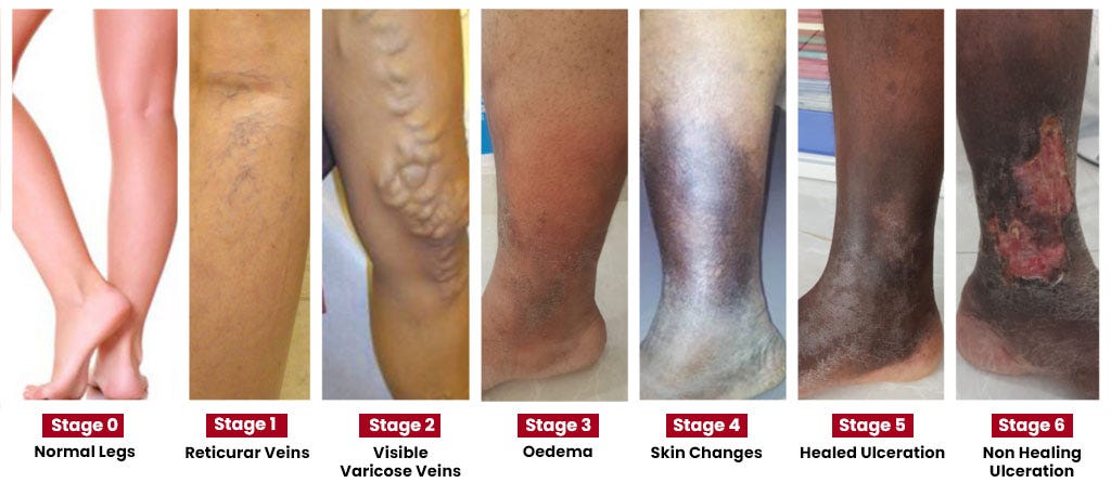Clinical stages of chronic venous disease from normal legs through varicose veins, skin changes and ulceration